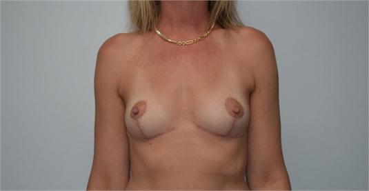 Breast Implant Removal After