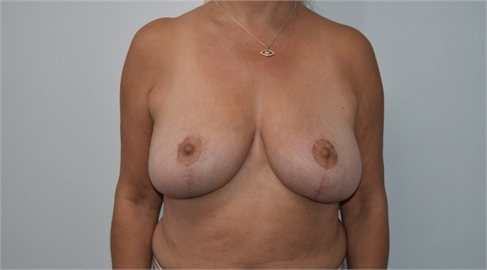 Breast Lift After