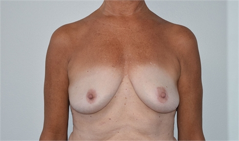Breast Implants Before