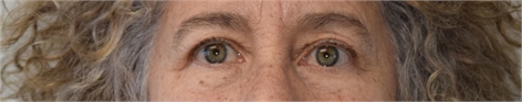 upper eyelid blepharoplasty Before