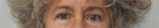 upper eyelid blepharoplasty After