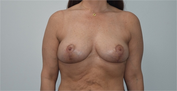 breast implant revision After