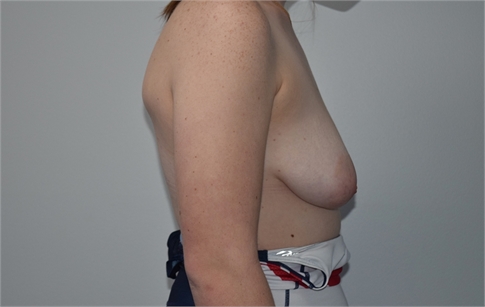 breast lift with mesh Before