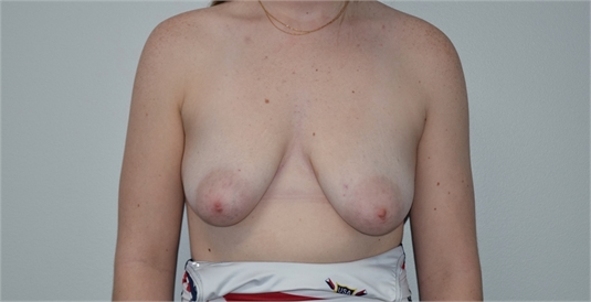breast lift with mesh Before