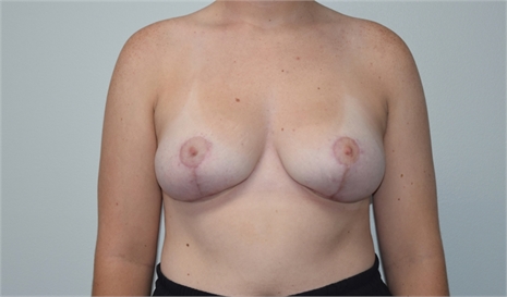 breast lift with mesh After