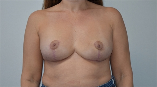 Explant Mastopexy After