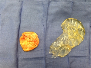 picture of ruptured silicone breast implant