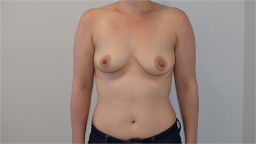Direct To Implant Breast Reconstruction Before