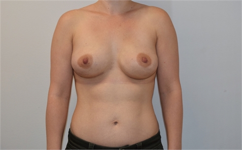 Direct To Implant Breast Reconstruction After