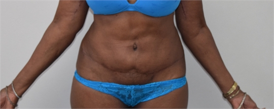 Abdominoplasty Before and After picture Los Angeles After