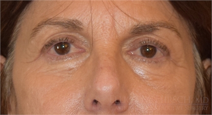 Blepharoplasty Upper Eyelid After