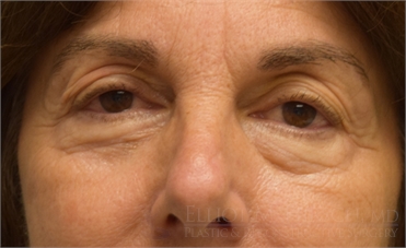 Blepharoplasty Upper Eyelid Before