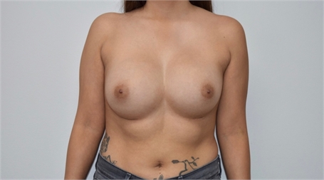 breast augmentation After