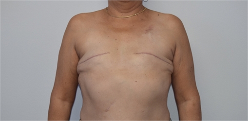 breast reconstruction Before