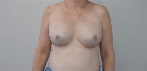 breast reconstruction After