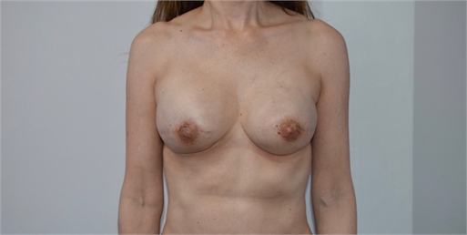 breast reconstruction After