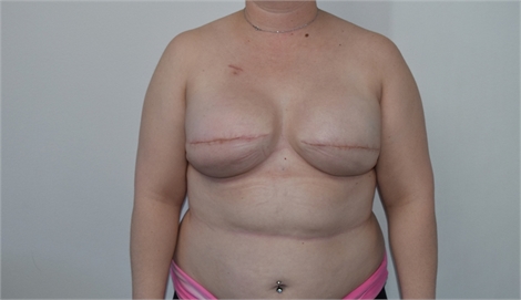 Two Stage Breast Reconstruction After