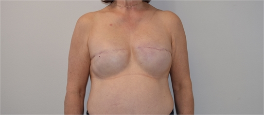 breast reconstruction revision Before