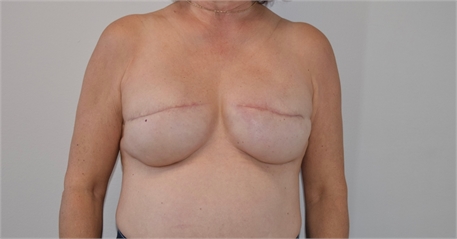breast reconstruction revision After