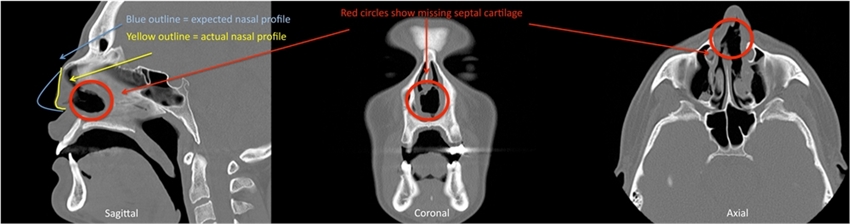 CT scan of a Los Angeles patient with cocaine nose