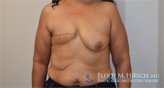Two Stage Breast Reconstruction Before