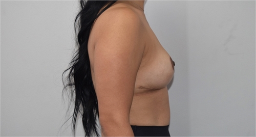 explant mastopexy After