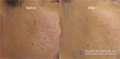 Los Angeles Microneedling Before and After picture