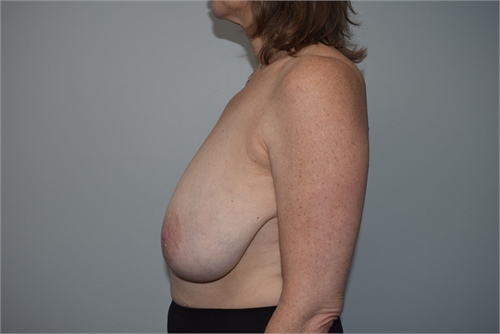Breast Reduction Before