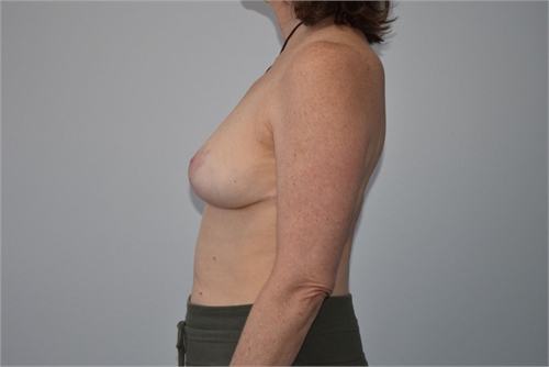 Breast Reduction After
