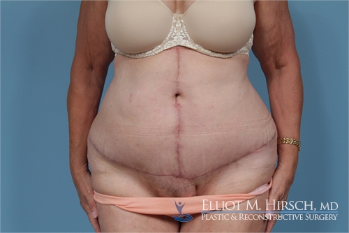 Fleur de lys tummy tuck After