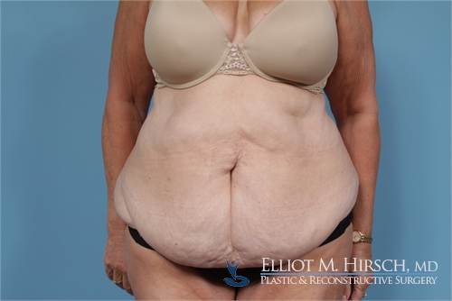 Tummy Tuck Before