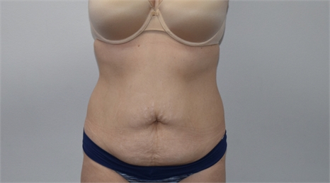 abdominoplasty Before