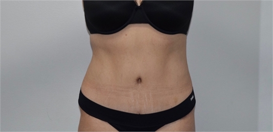 abdominoplasty After