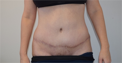 Abdominoplasty After