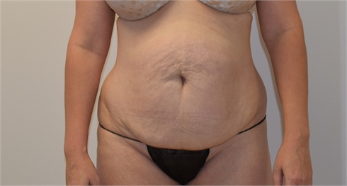 Abdominoplasty Before