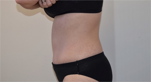 Abdominoplasty After