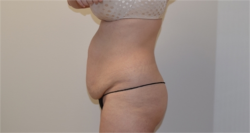 Abdominoplasty Before