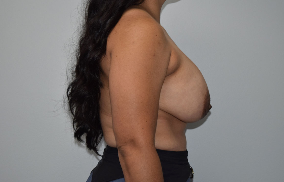 Explantlift10 Before (Lateral)