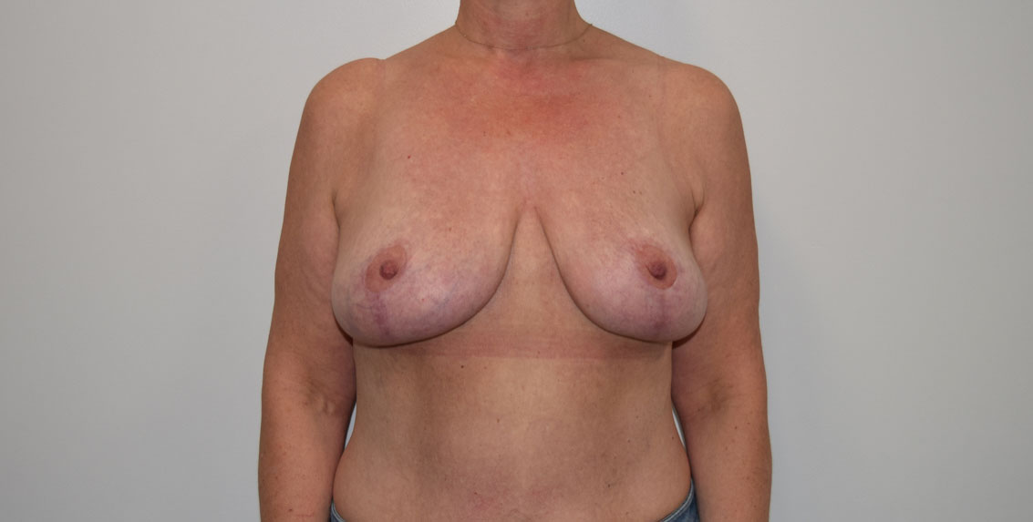 Explantlift13 After (AP)