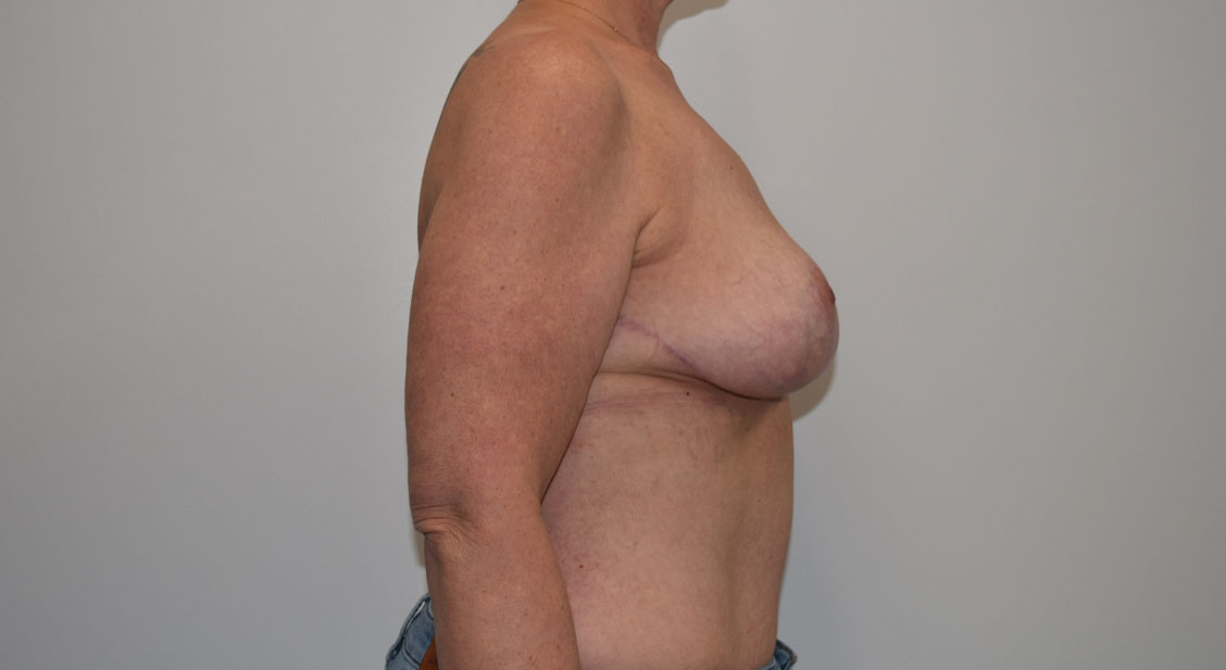 Explantlift13 After (Lateral)