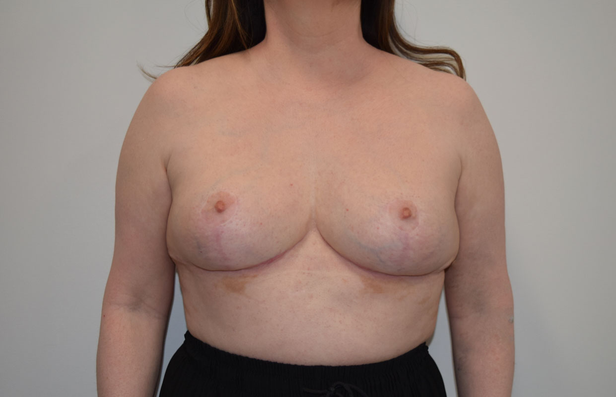 Explantlift1 After (AP)