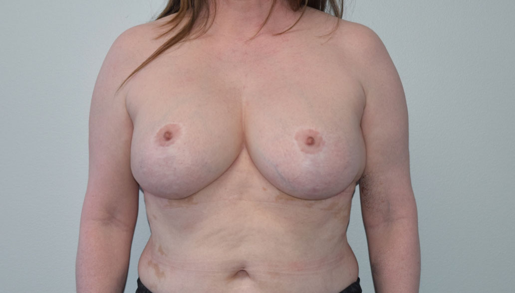 Explantlift1 Before (AP)