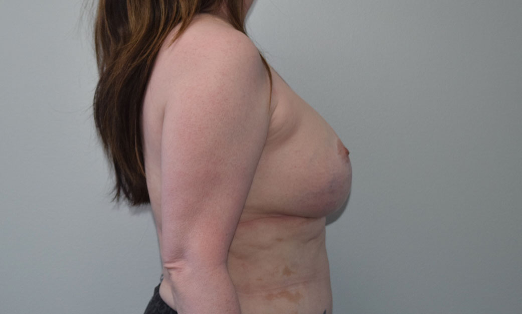 Explantlift1 Before (Lateral)