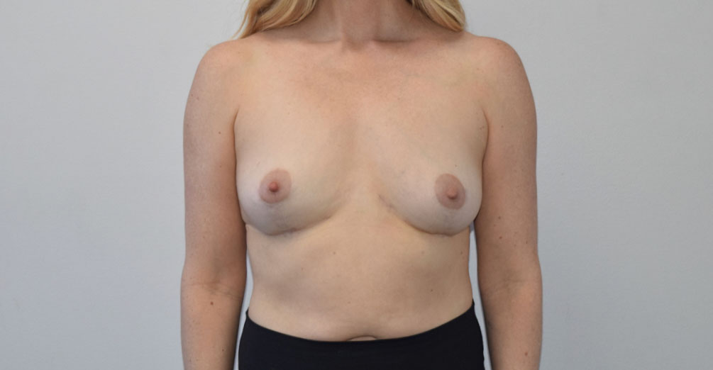 Breast Reduction After (AP)