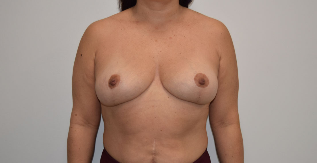 Breast Reduction After Surgery Image