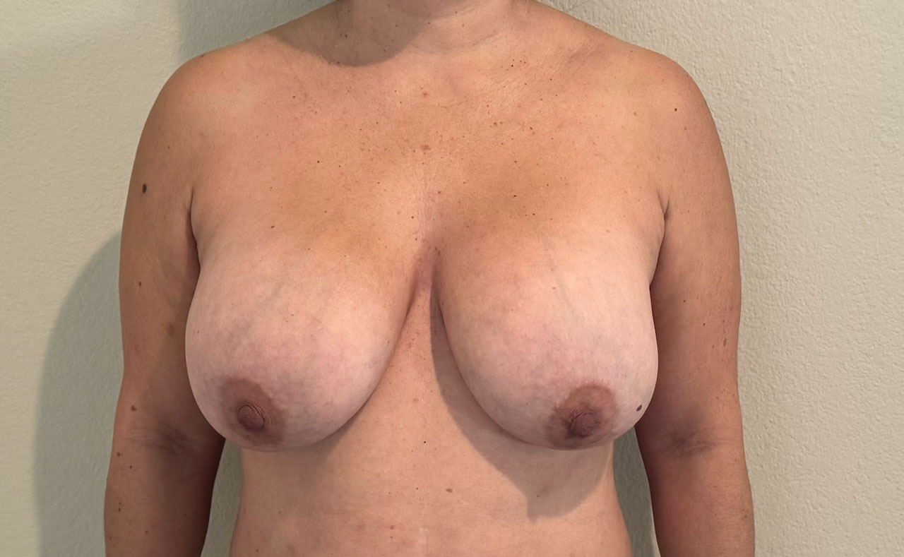 Breast Reduction Before Surgery Image
