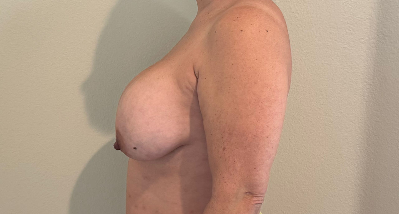 Breast Reduction Before Image