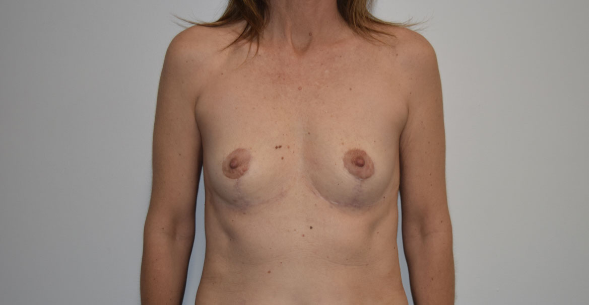 Explantlift6 After (AP)