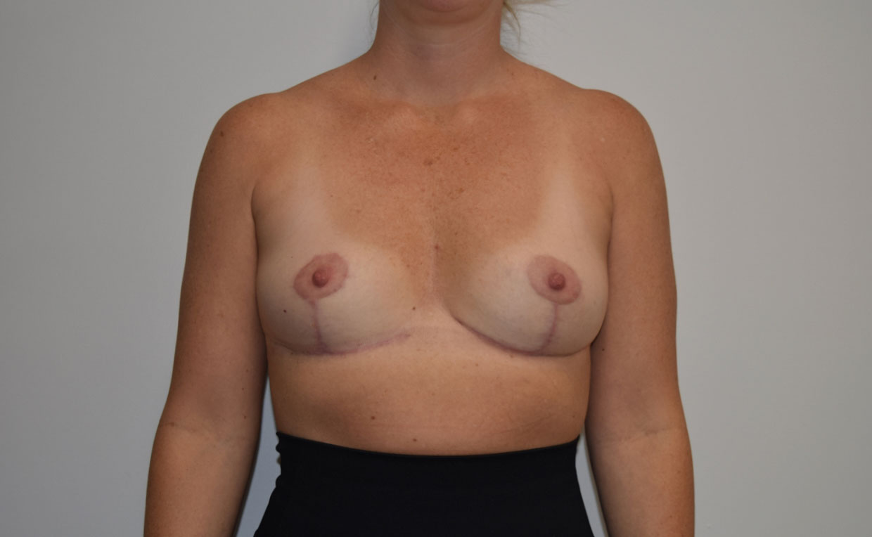 Explantlift7 After (AP)