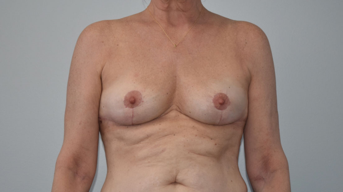 Explantlift8 After (AP)